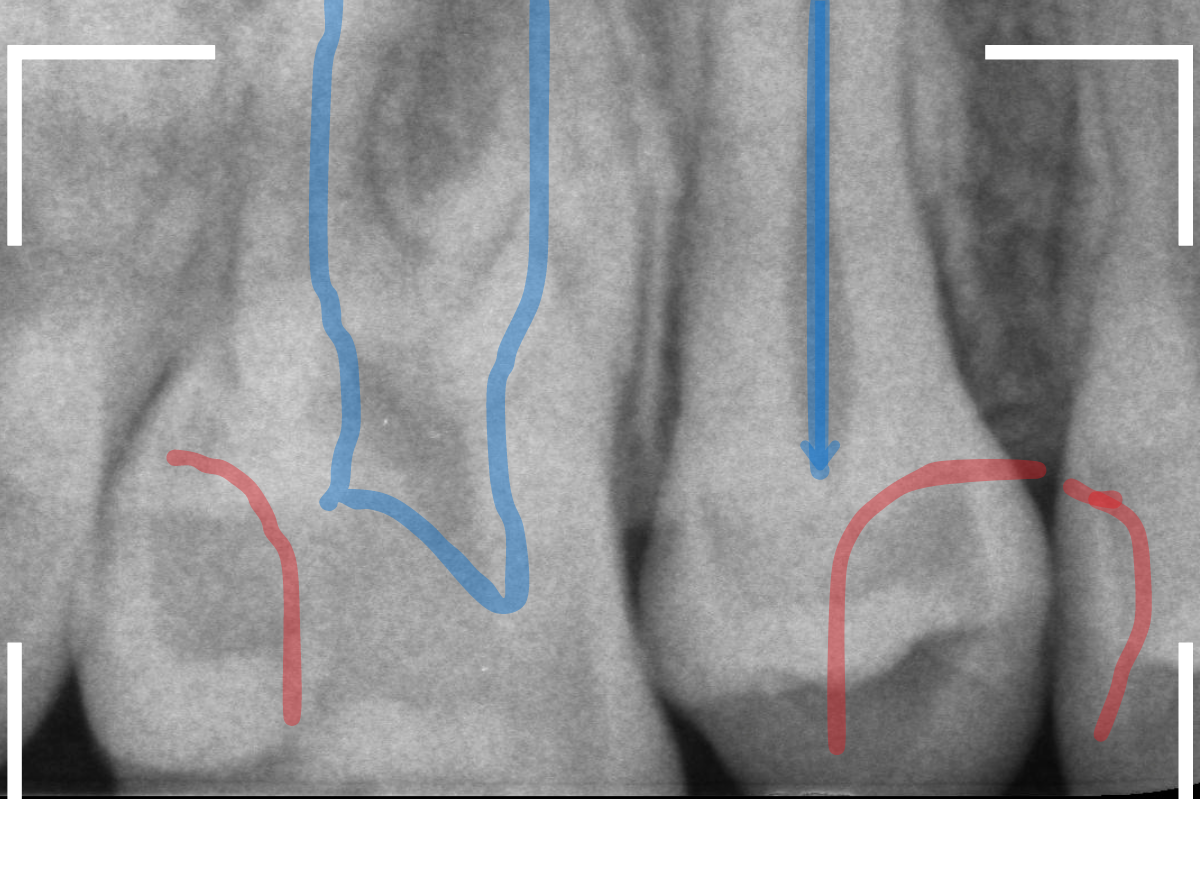 セラミック治療(インレー)32-2