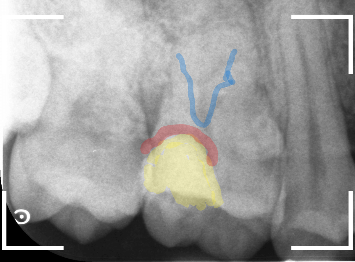 つめものの下の深い深い虫歯20-1