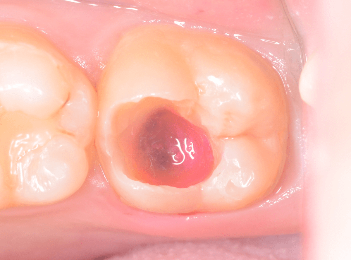 つめものの下の深い深い虫歯1-5
