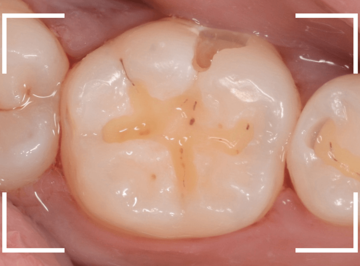 レントゲンでわかりづらい虫歯4-4