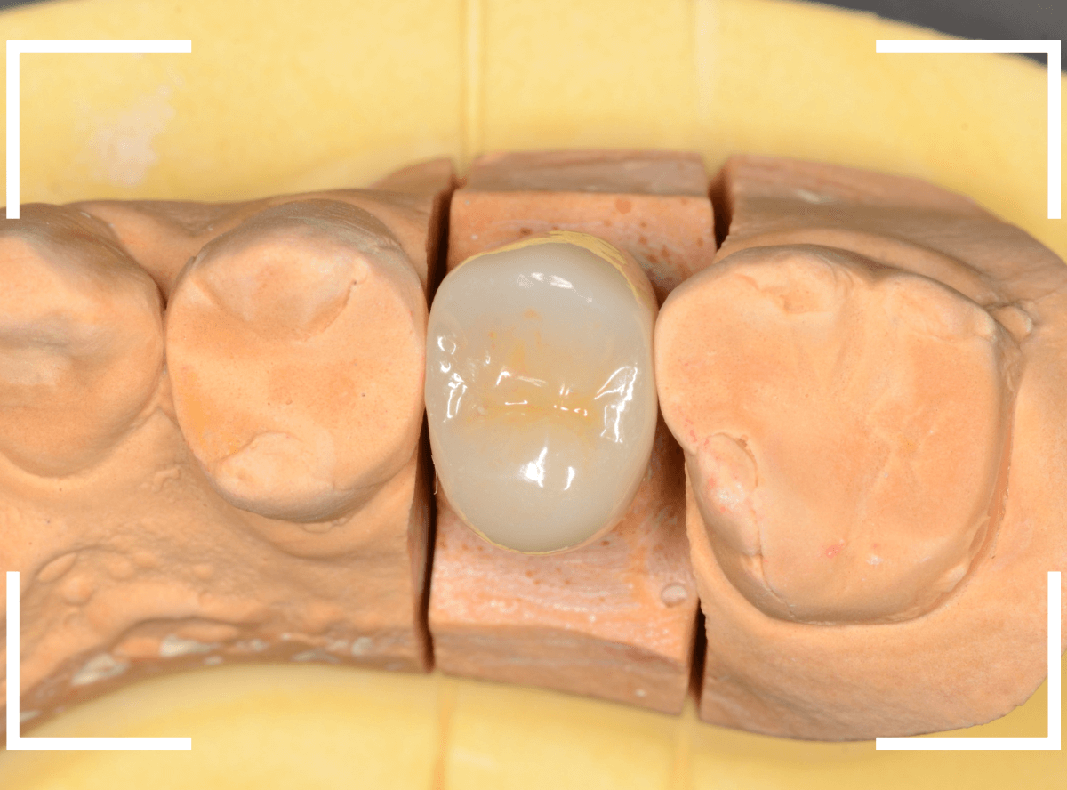 セラミック治療(クラウン・奥歯)13-3