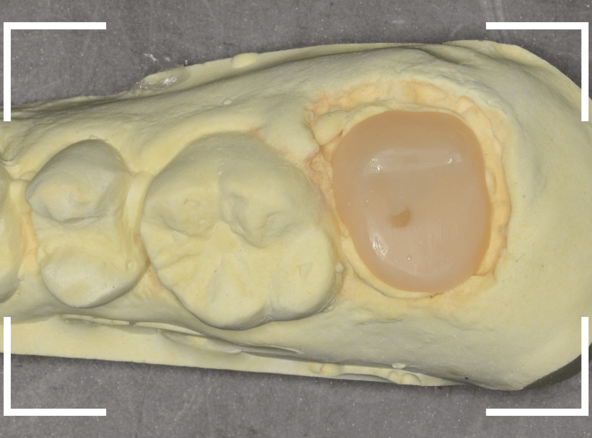セラミック治療(クラウン・奥歯)10-4
