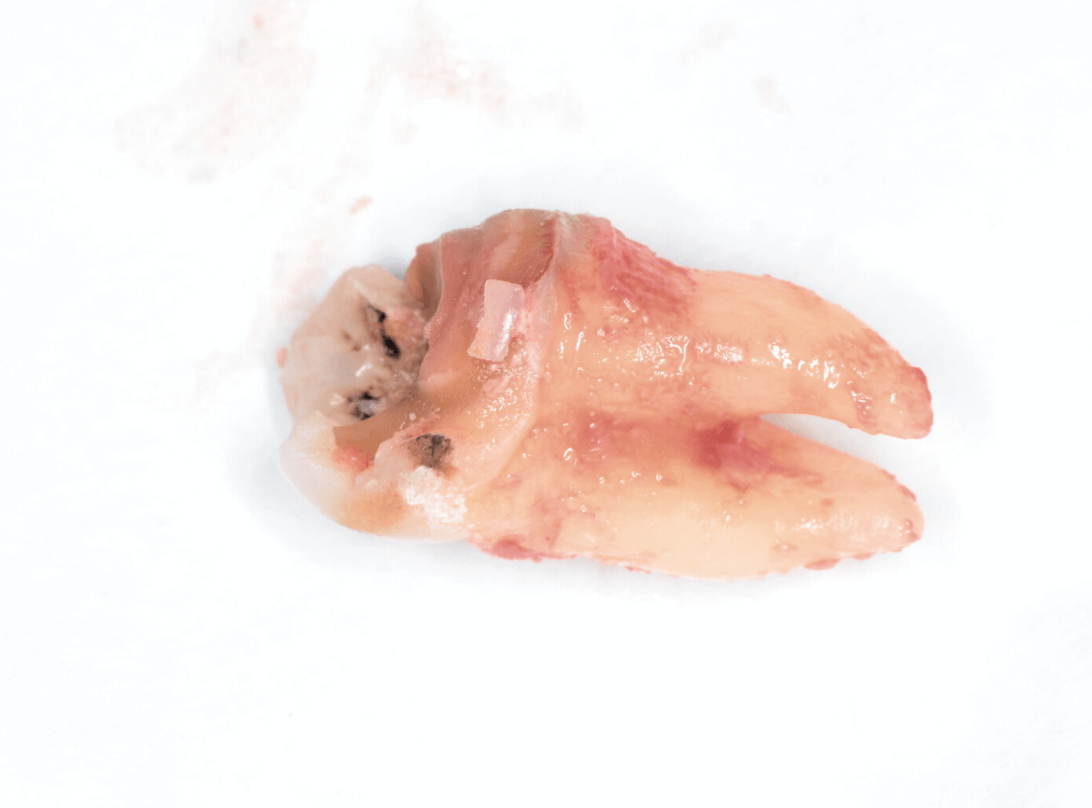 おやしらずの抜歯18-3