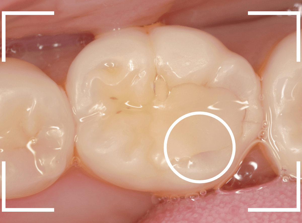 レントゲンでわかりづらい虫歯18-1
