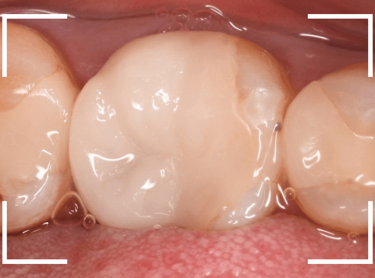 セラミック治療(クラウン・奥歯)7-1