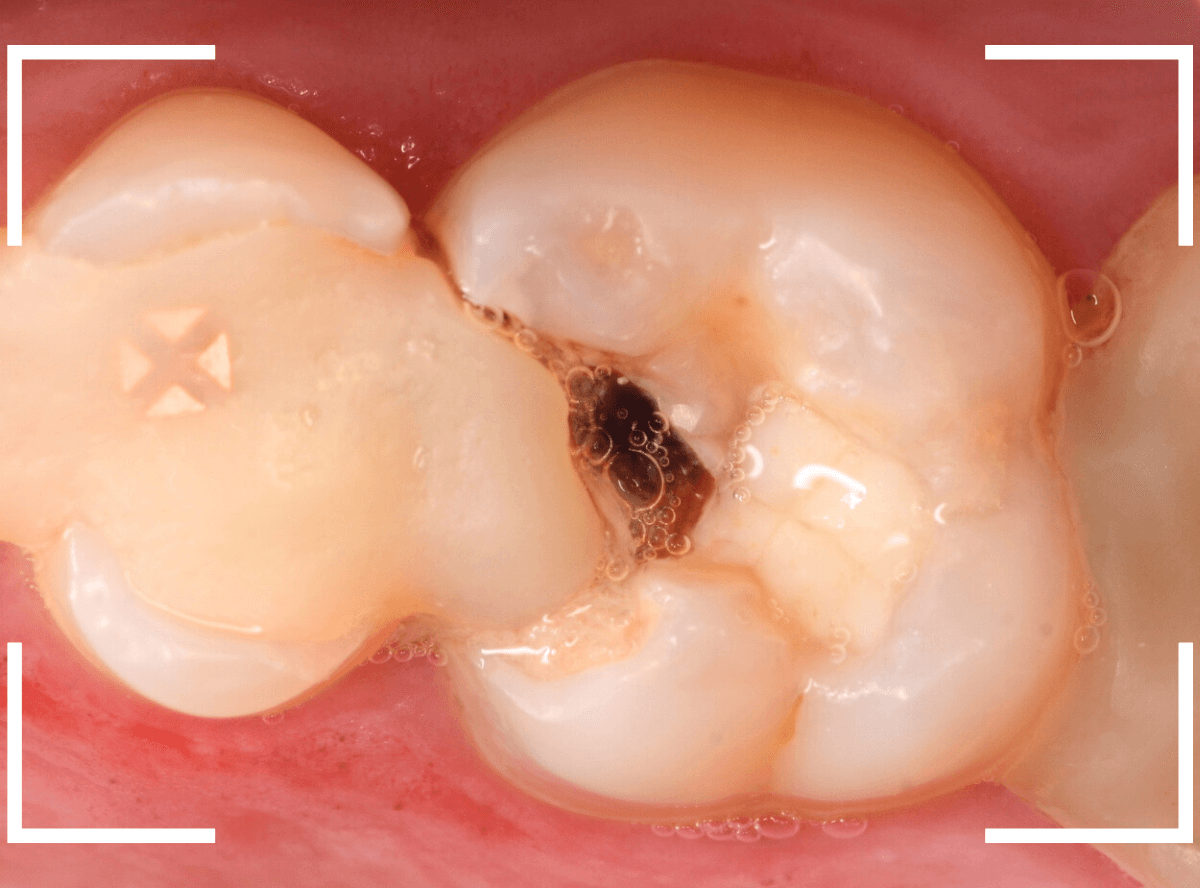つめものの下の深い深い虫歯20-1