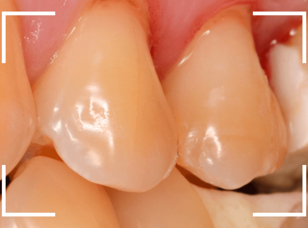 セラミック治療(インレー)21-5