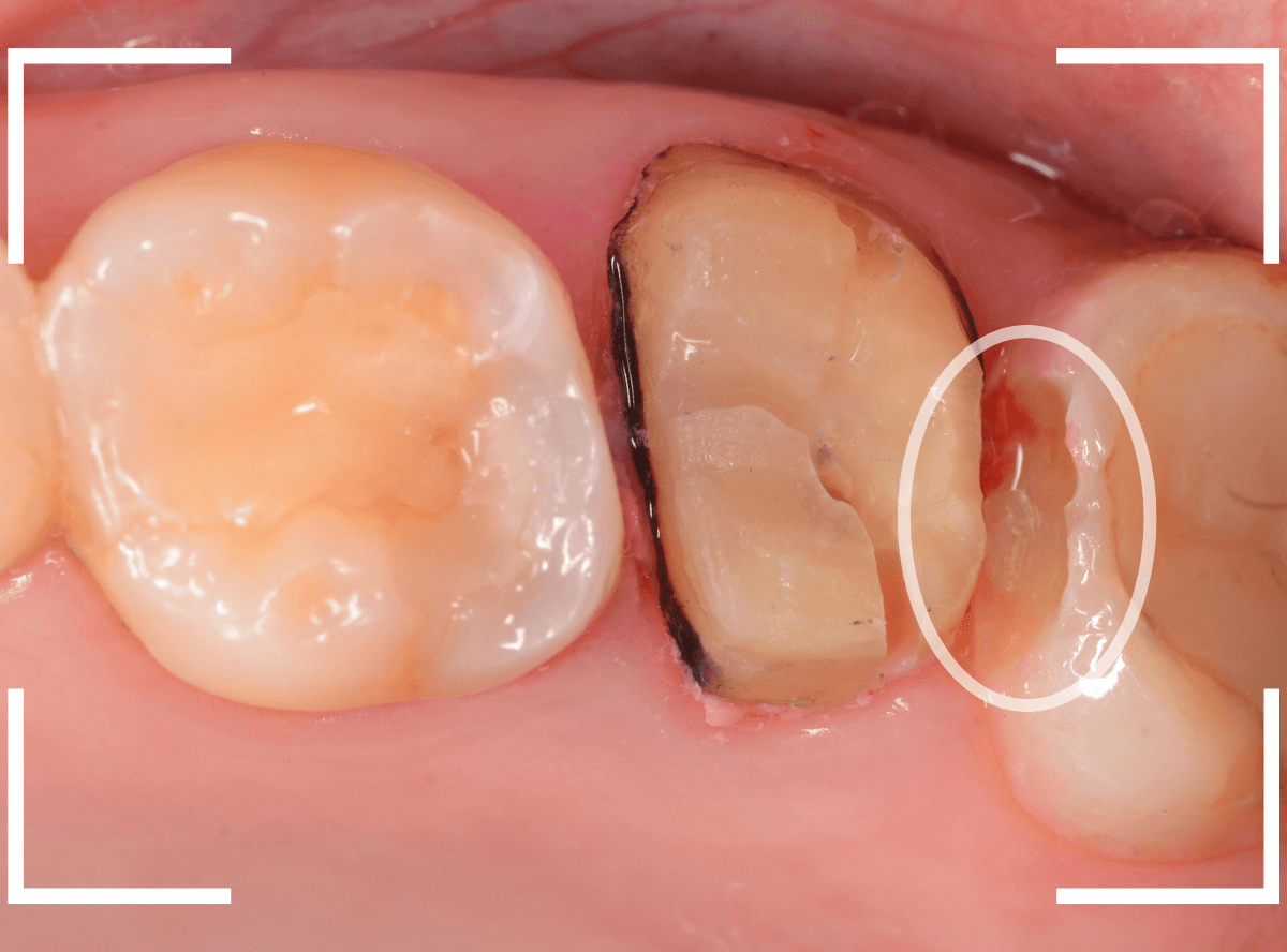 メタル・フリー治療の実際21-2