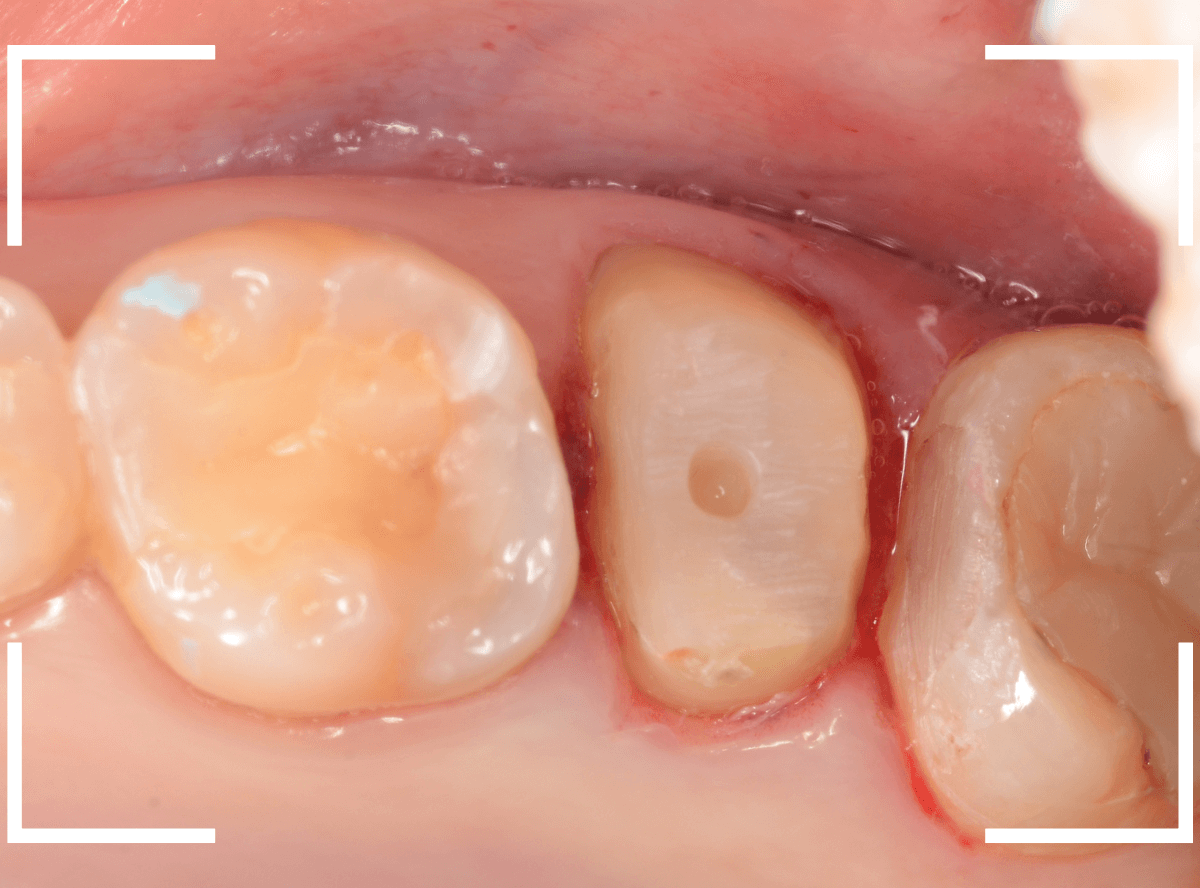 メタル・フリー治療の実際21-3