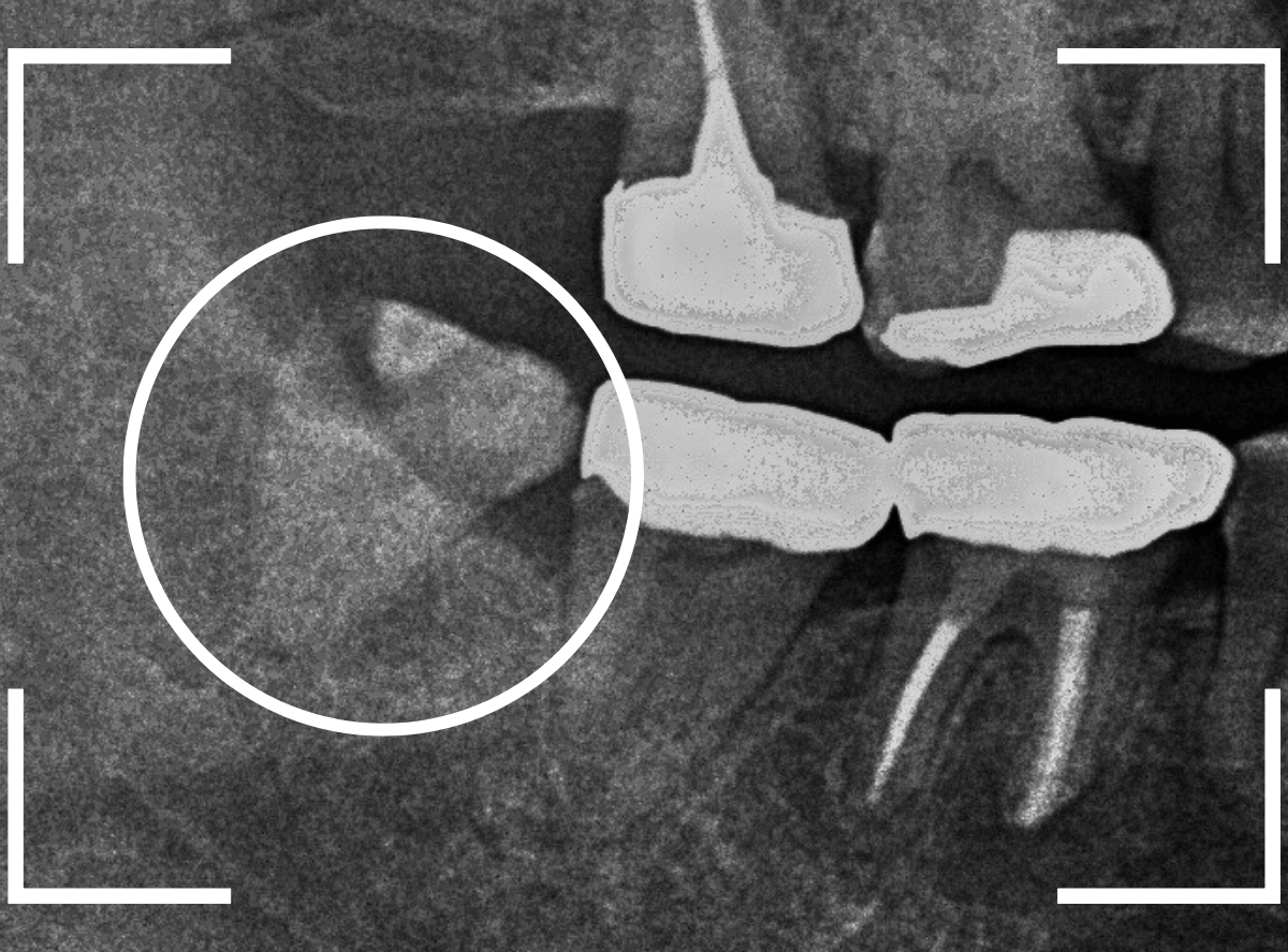 おやしらずの抜歯15-2