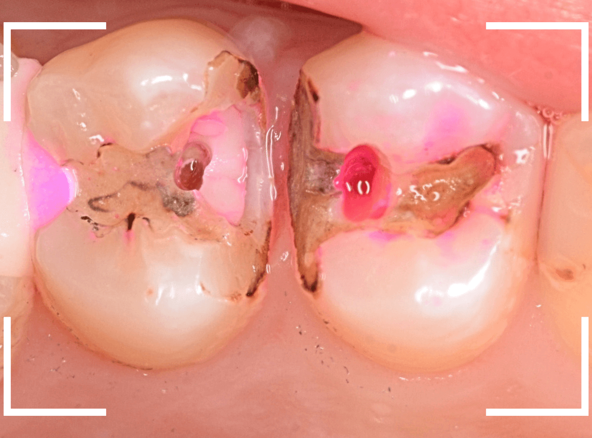 つめものの下の深い虫歯(画像)10-1
