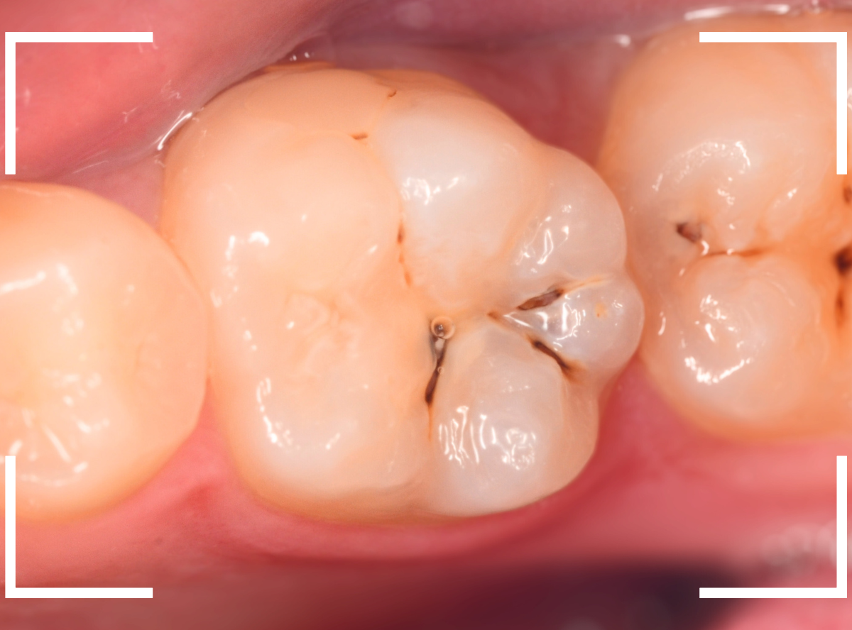 小窩裂溝う蝕5-1