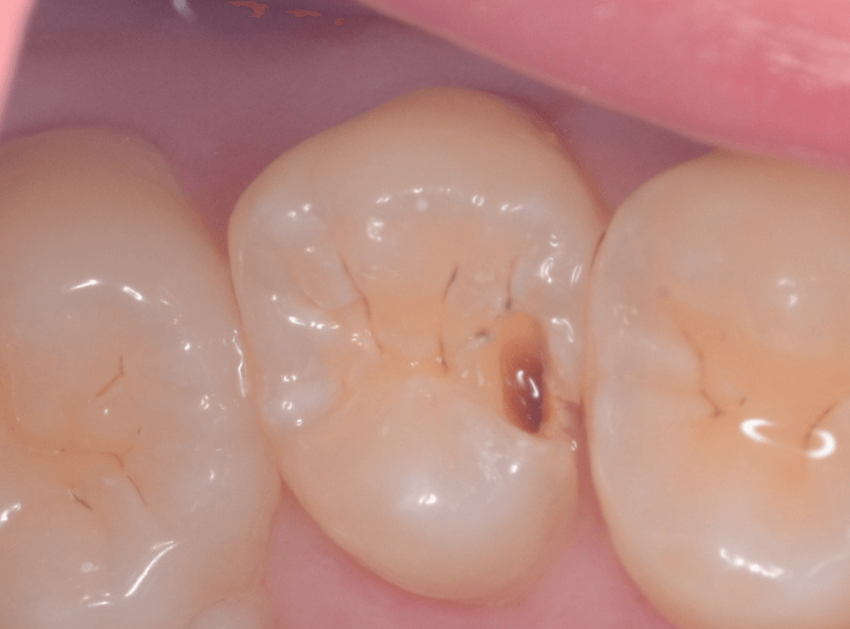 レントゲンでわかりづらい虫歯2-4
