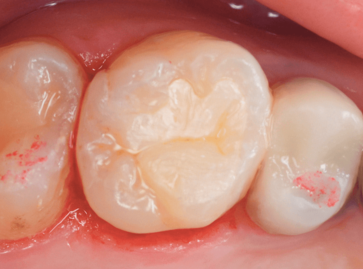 セラミック治療(インレー)2-3