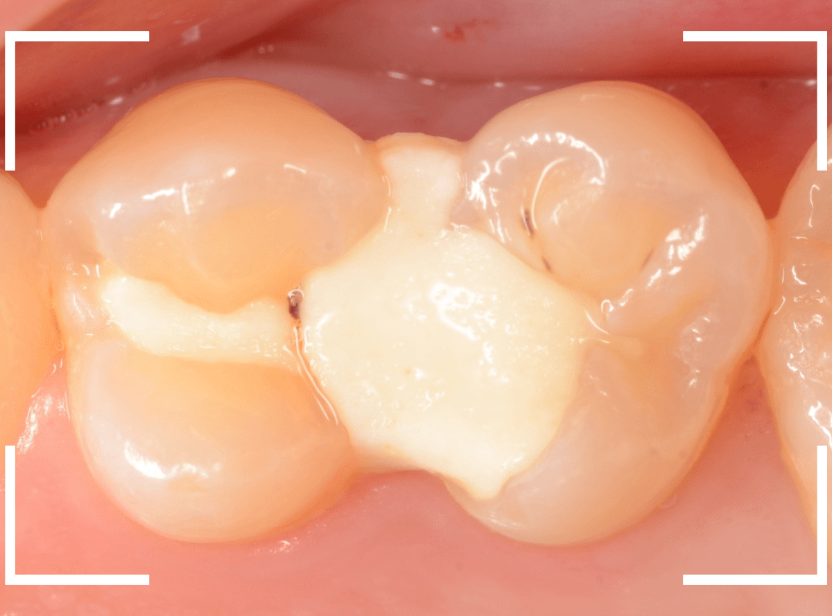 セラミック治療(インレー)28-1