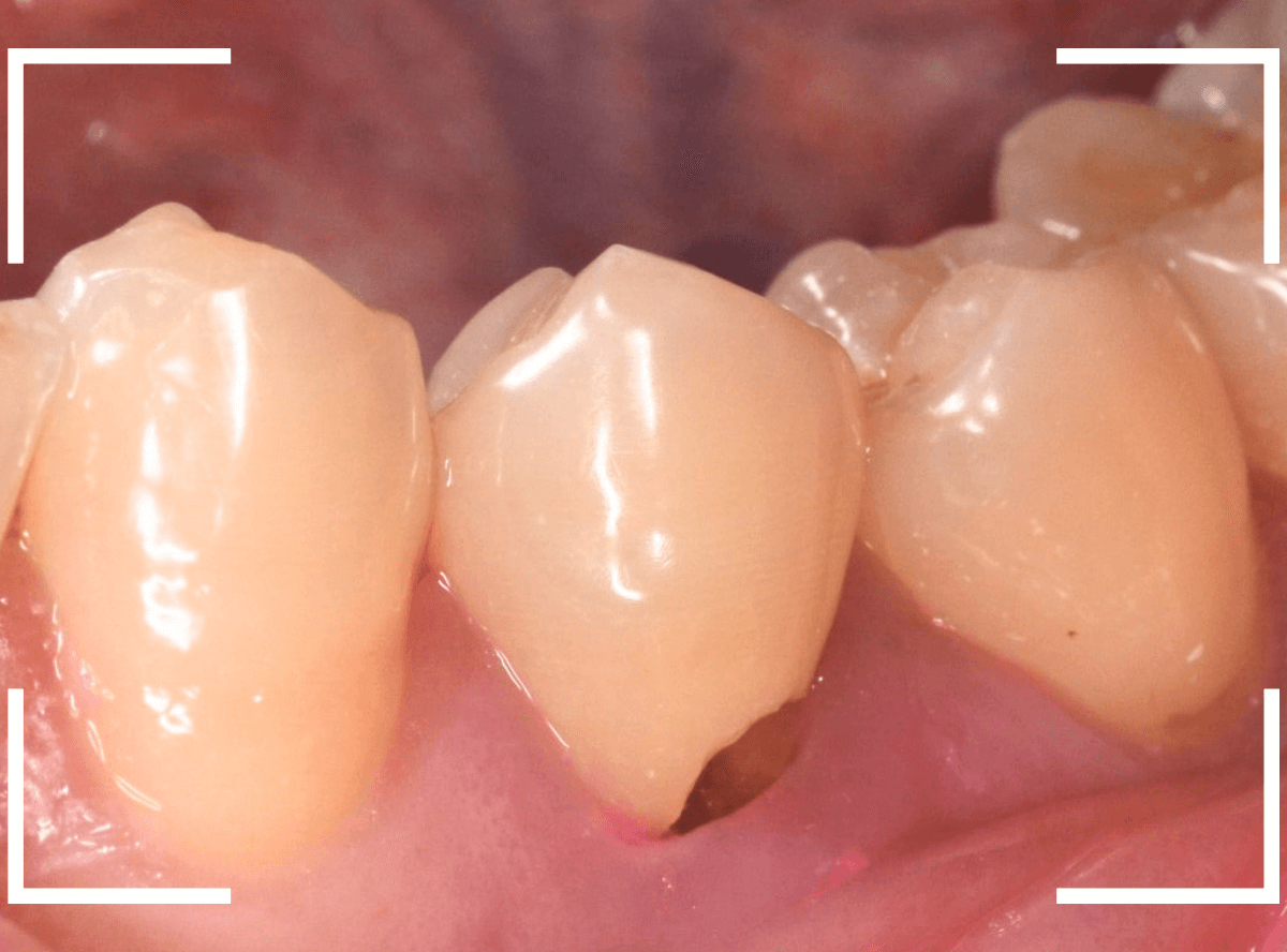 歯頚部う蝕の治療5