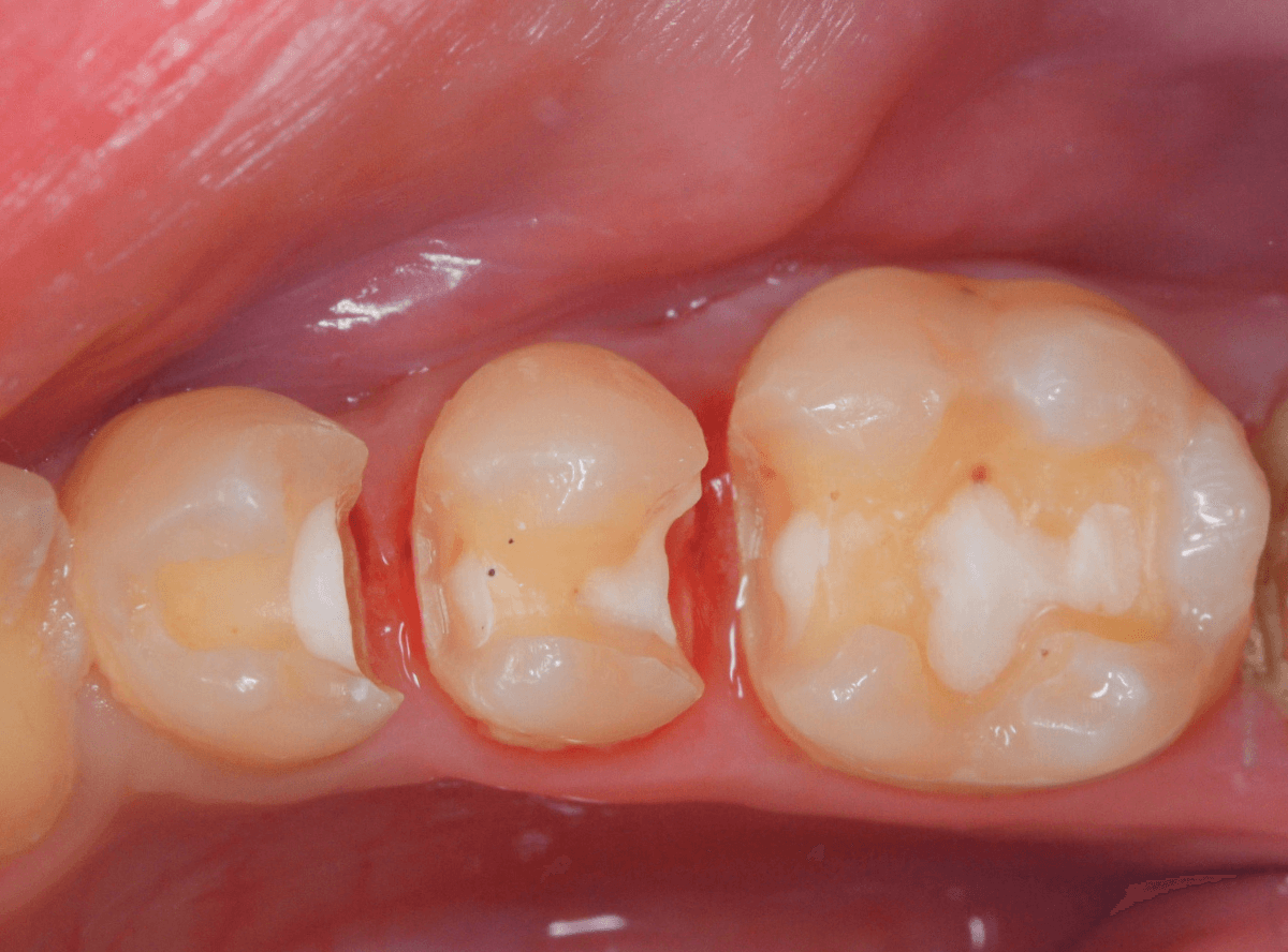 セラミック治療(インレー)4-1