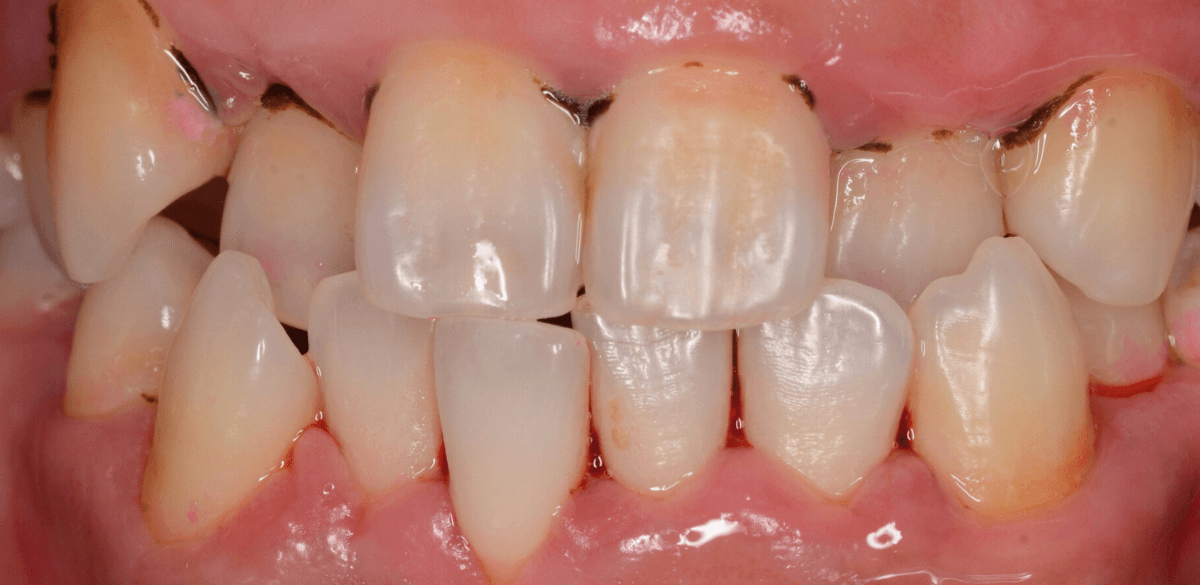 歯肉の中の歯石（歯肉縁下歯石）除去(画像）4-1