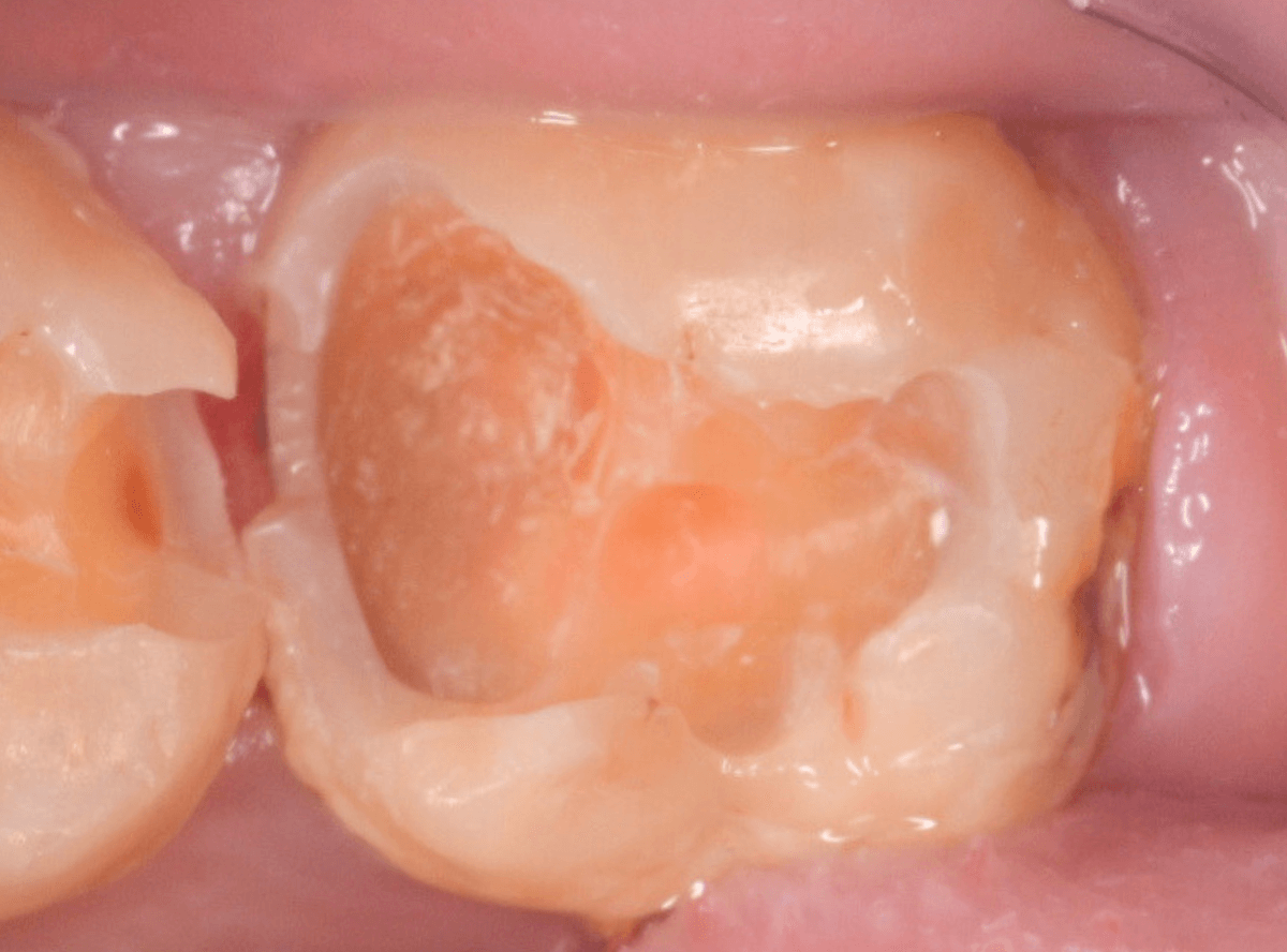 つめものの下の深い虫歯(画像)3-5