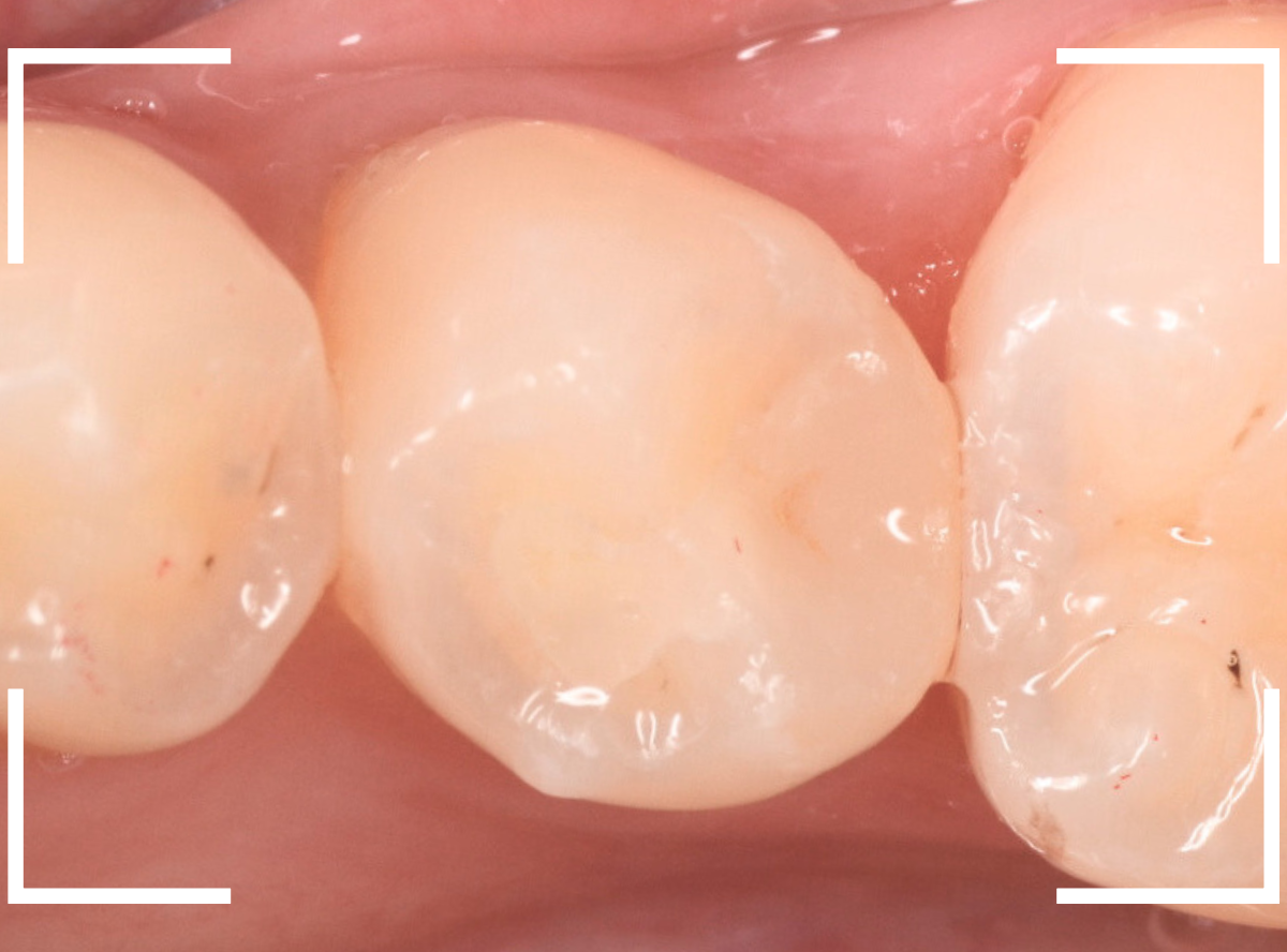 セラミック治療(インレー)23-6