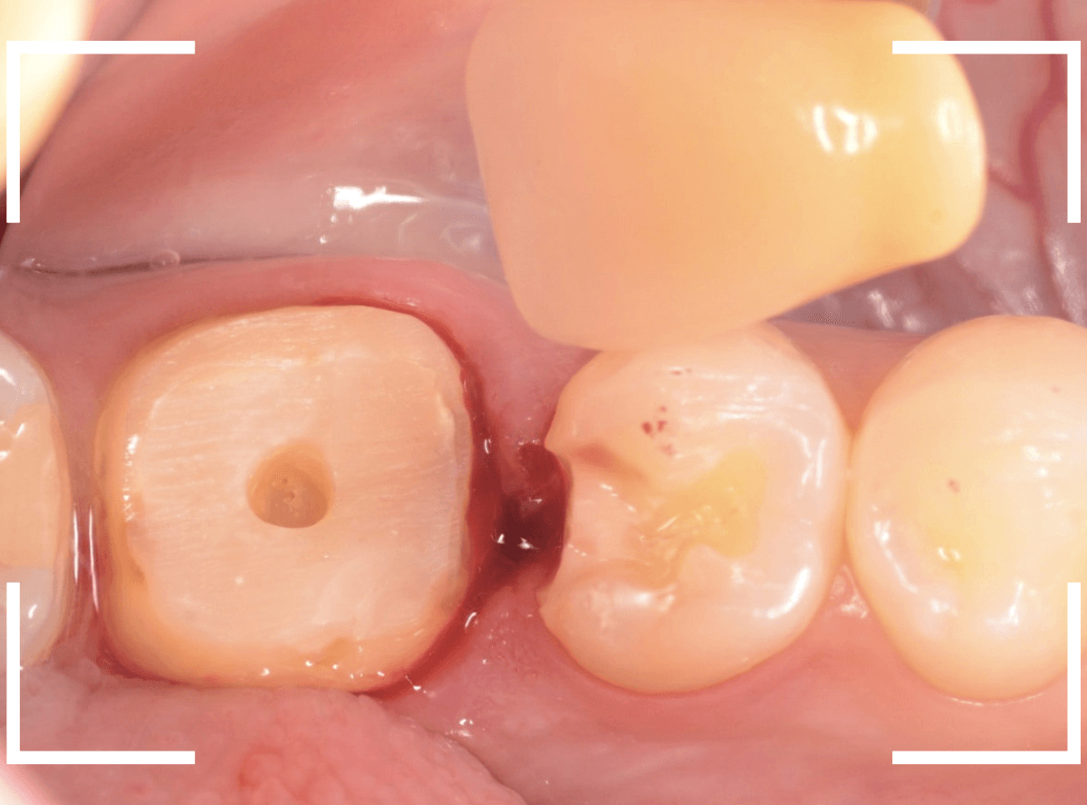 セラミック治療(クラウン・奥歯)9-3