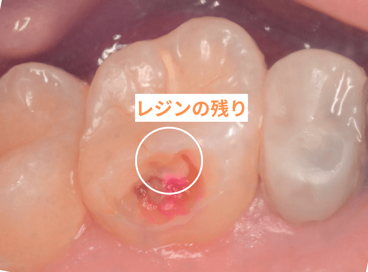 レントゲンでわかりづらい虫歯1-4