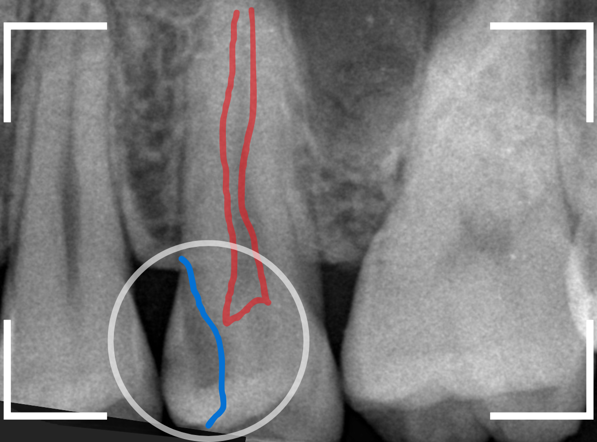 歯と歯の間の虫歯11-1