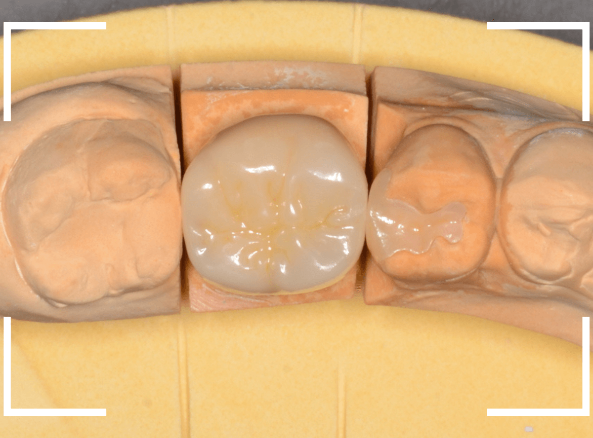 セラミック治療(クラウン・奥歯)9-4