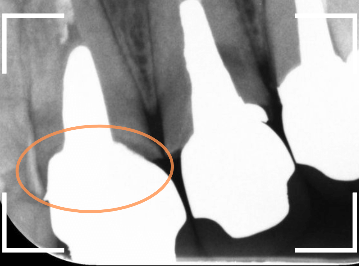 歯肉の中の歯石（歯肉縁下歯石）除去(画像）5-3