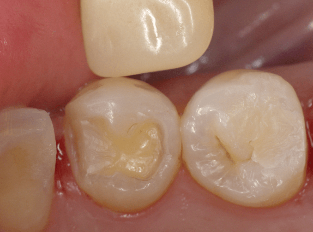 セラミック治療(インレー)13-2
