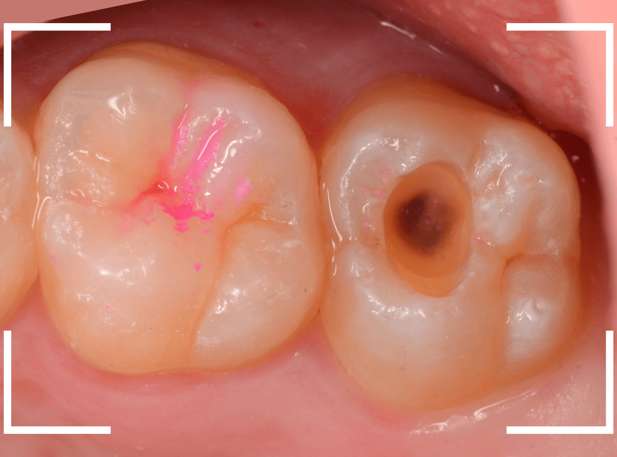 小窩裂溝う蝕4-4