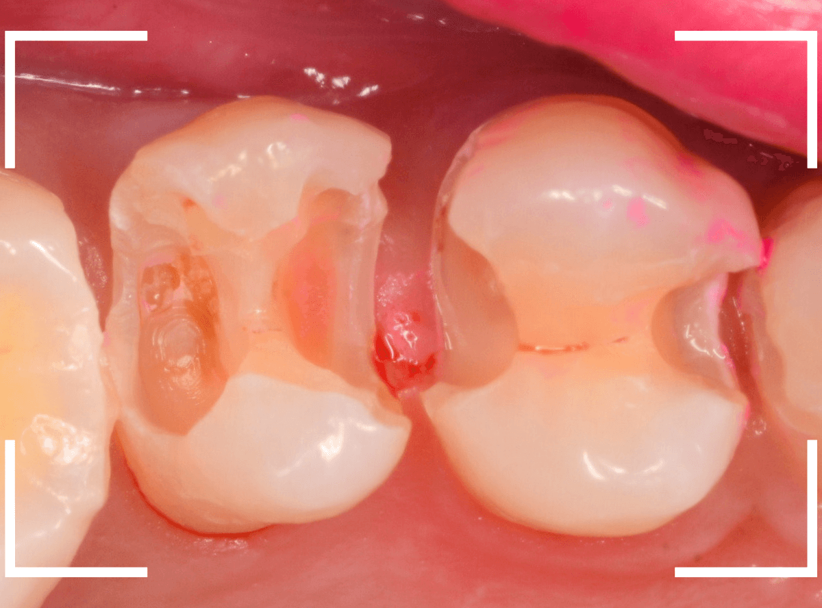 気づかないうちに深い虫歯8-4