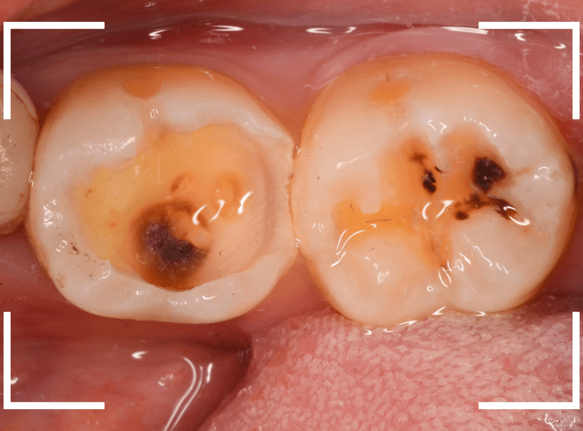 小窩裂溝う蝕2-5