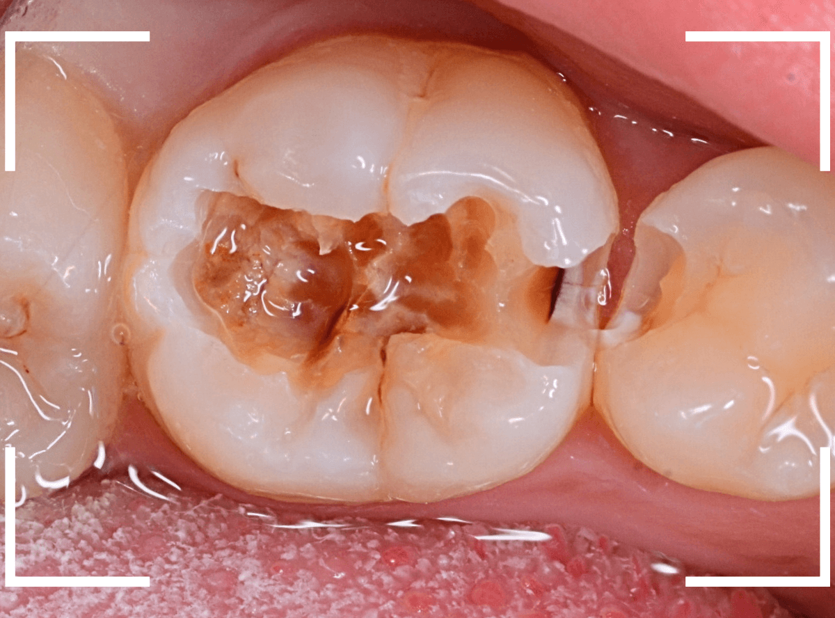 小窩裂溝う蝕1-5