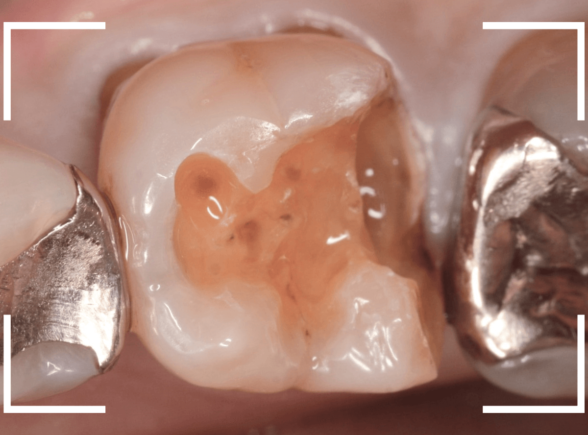 セラミック治療(インレー)17-2