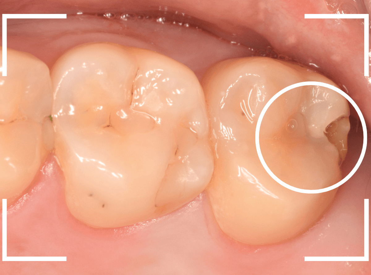 気づかないうちに深い虫歯5-1