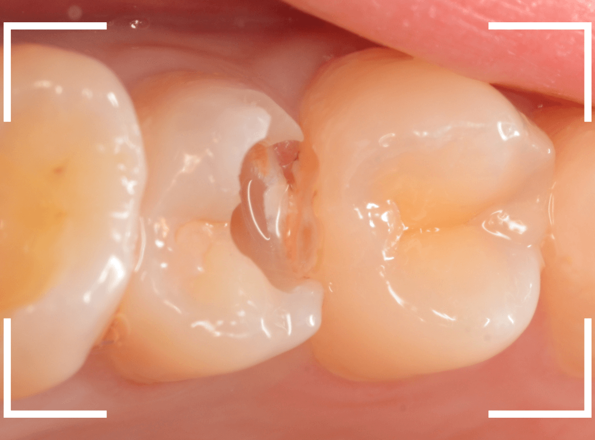 セラミック治療(インレー)32-8