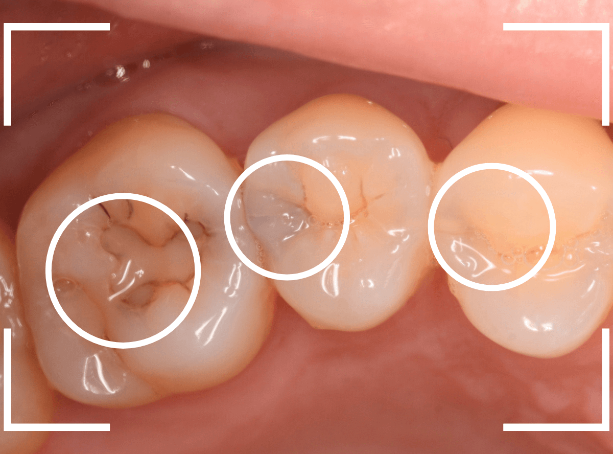 レントゲンでわかりづらい虫歯9-1