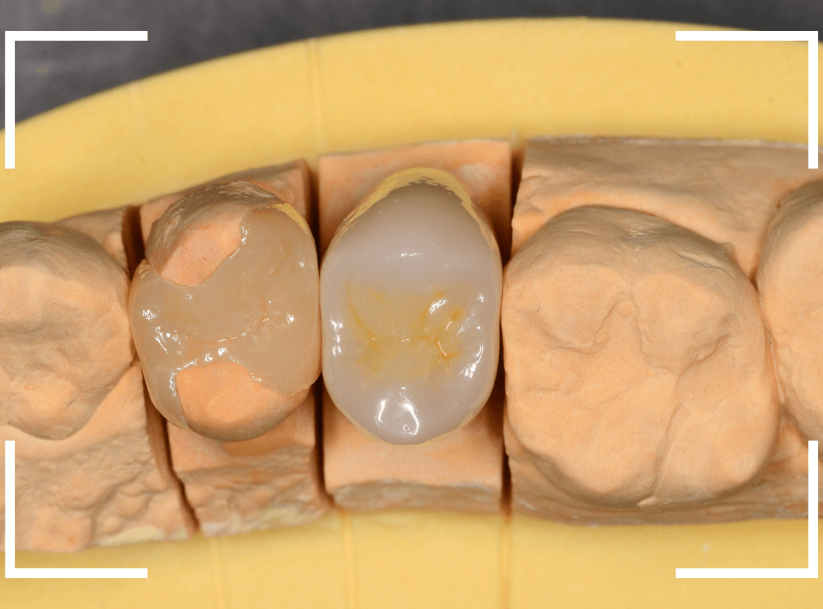 セラミック治療(クラウン・奥歯)9-8