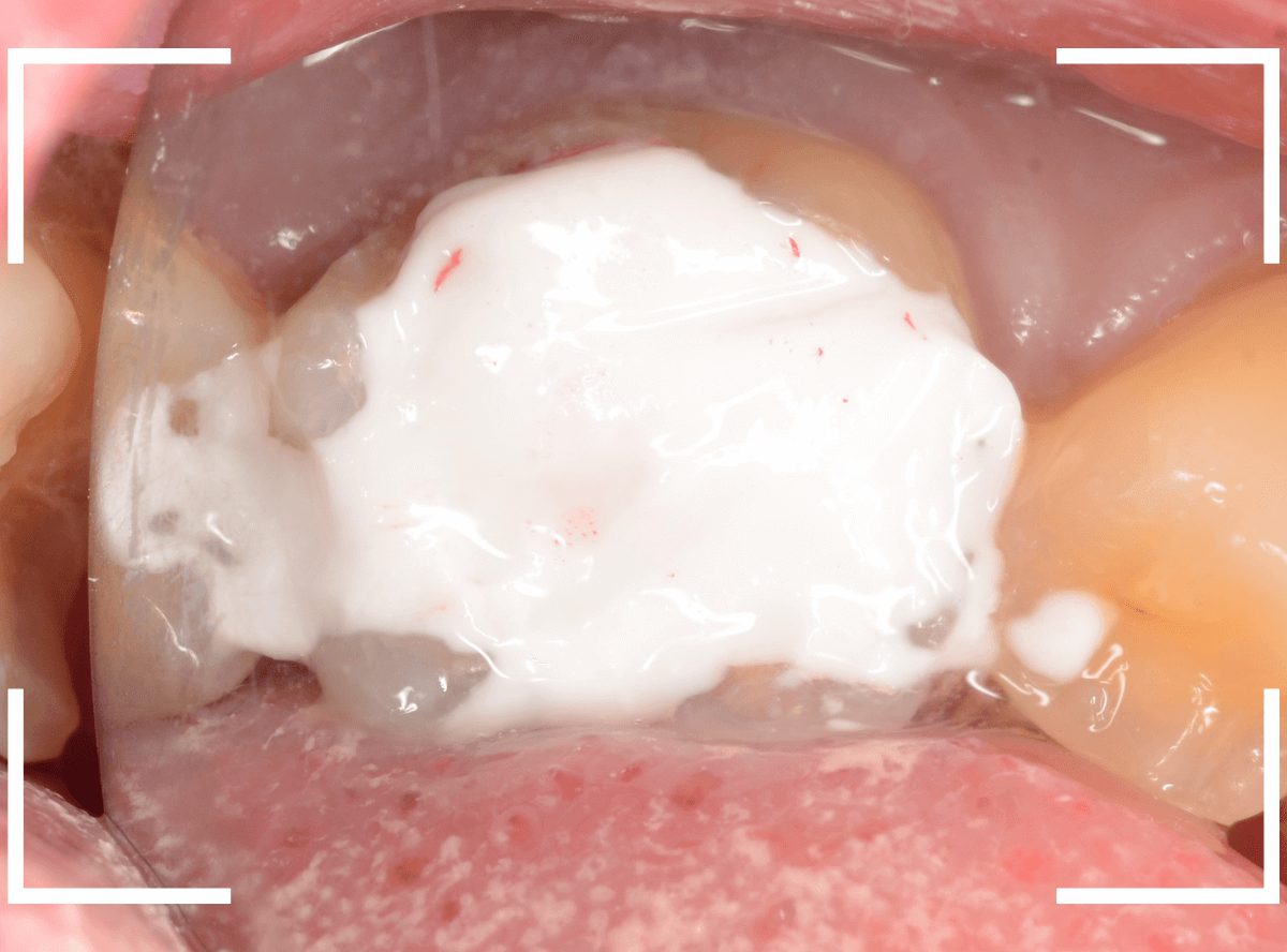 レントゲンでわかりづらい虫歯21-6