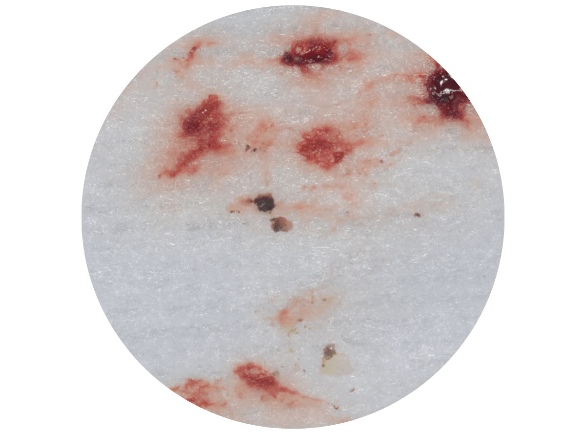 歯肉の中の歯石（歯肉縁下歯石）除去(画像）2-3