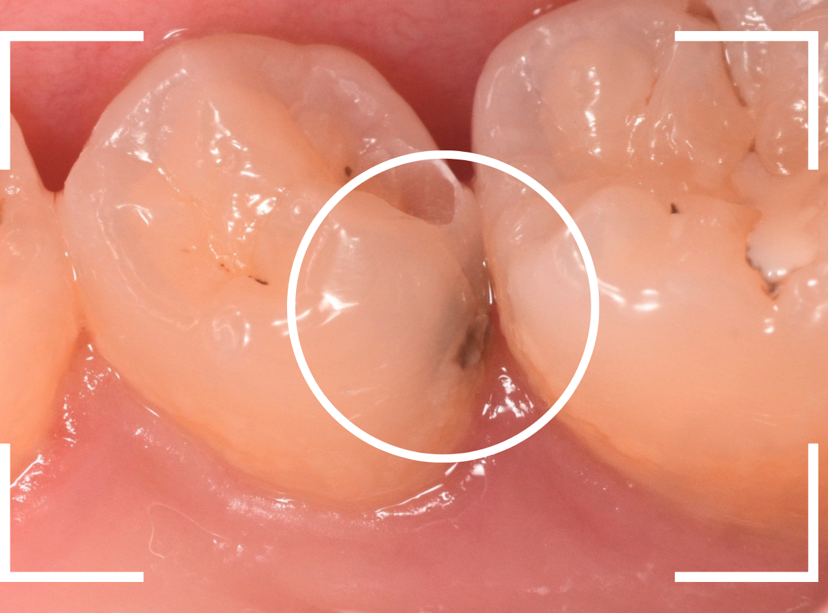 セラミック治療(インレー)23-3