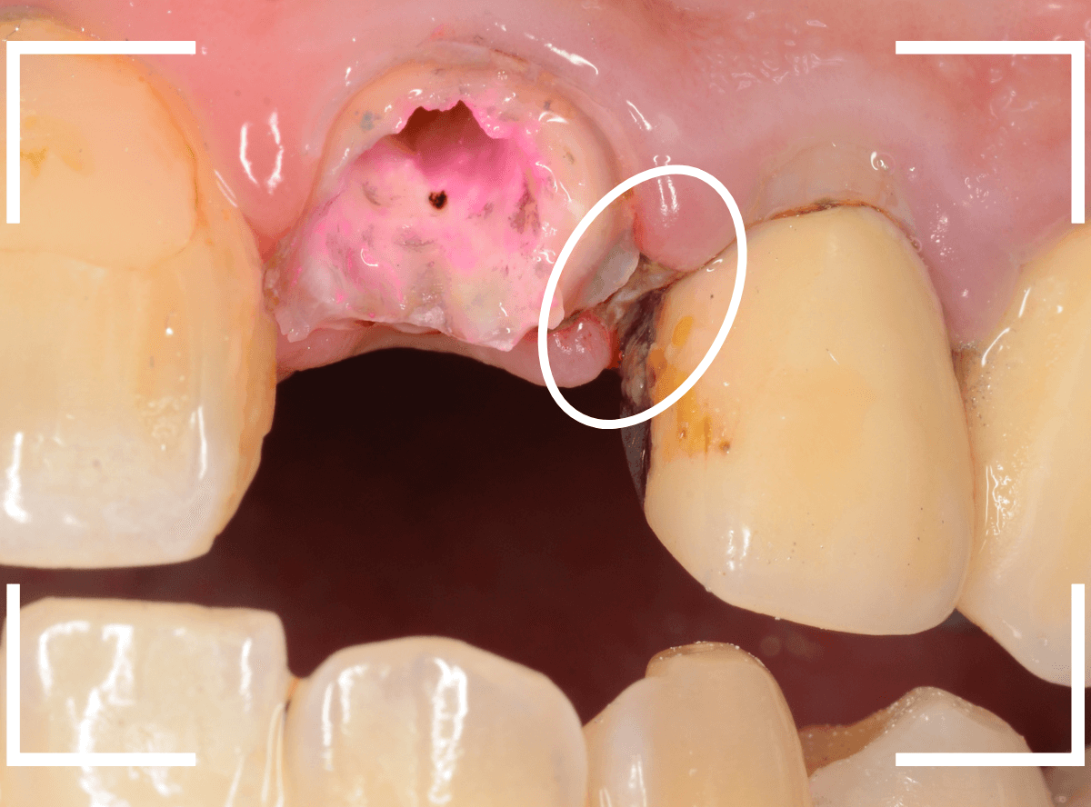 歯肉の中の歯石（歯肉縁下歯石）除去(画像）5-6