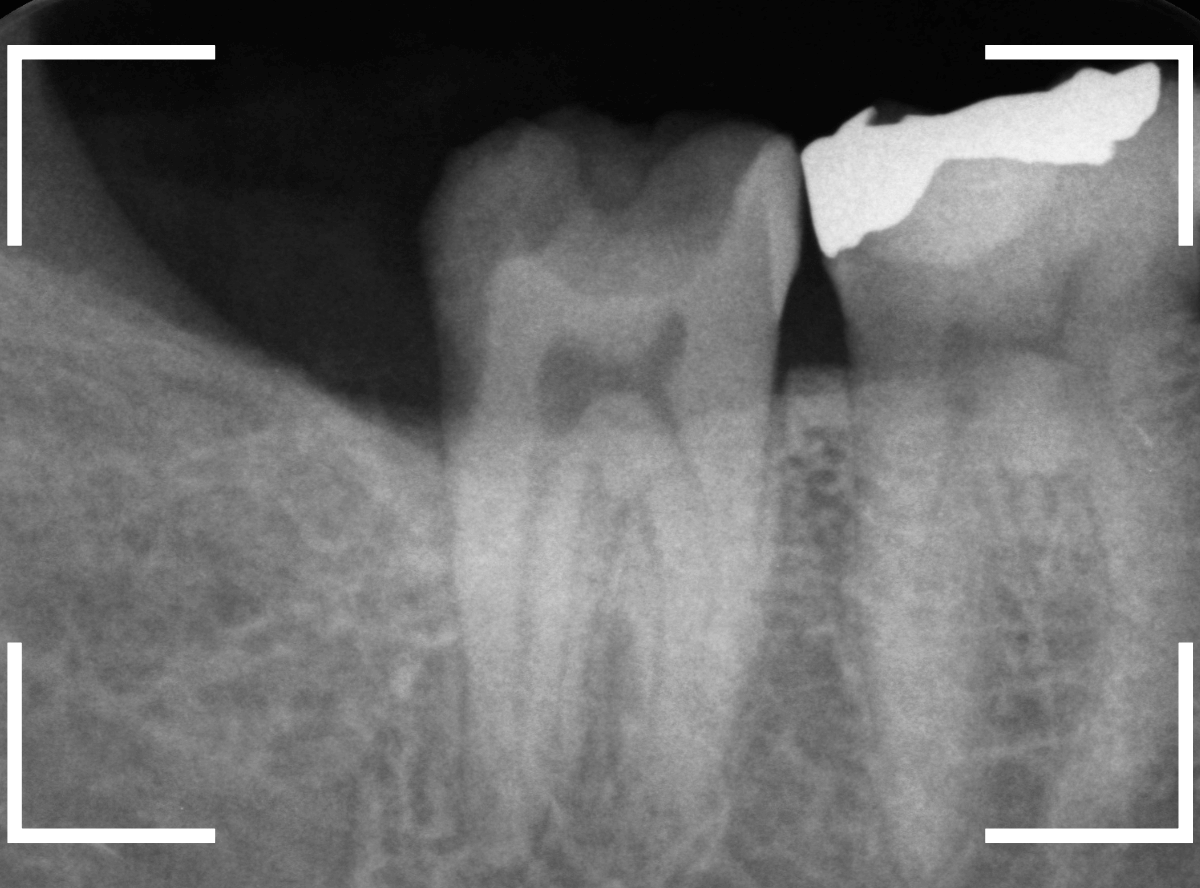 気づかないうちに深い虫歯13-6