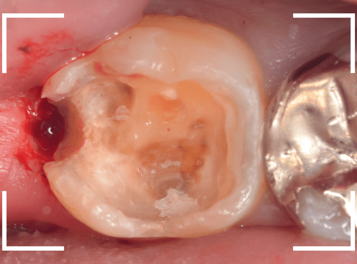 気づかないうちに深い虫歯13-4