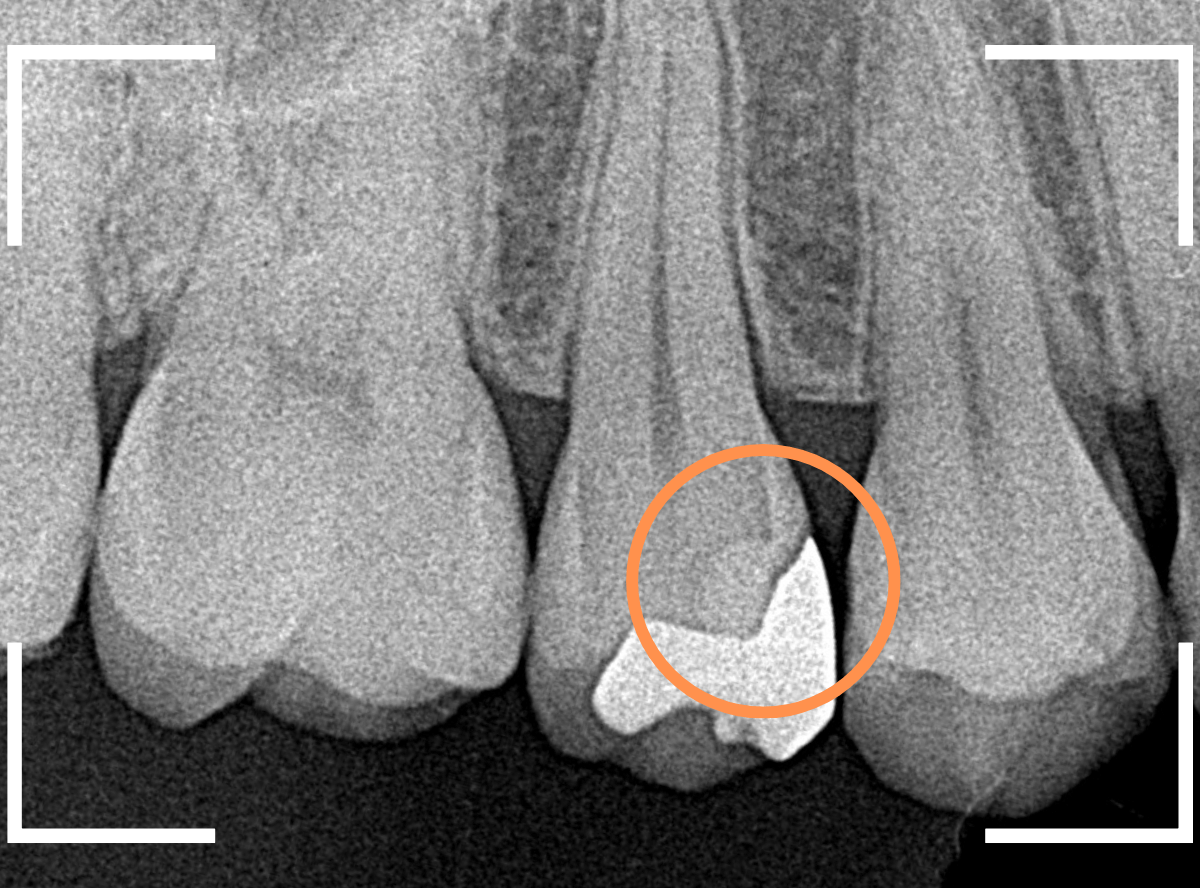 セラミック治療(インレー)27-2