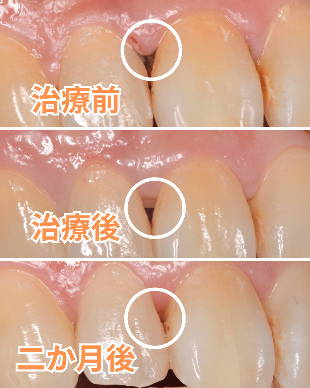 歯肉の中の歯石（歯肉縁下歯石）除去(画像）2-5