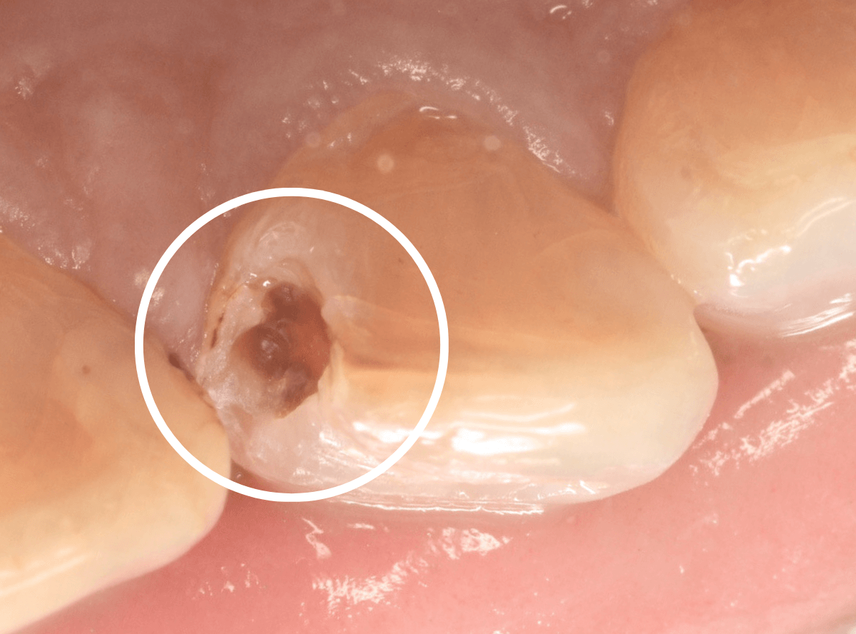 コンポジットレジン治療3-2