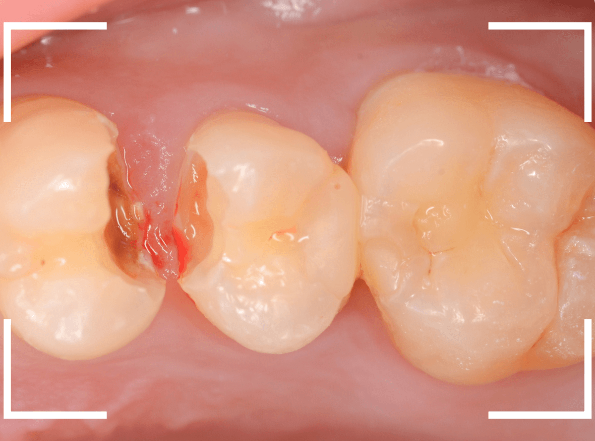 つめものの下の深い深い虫歯17-4