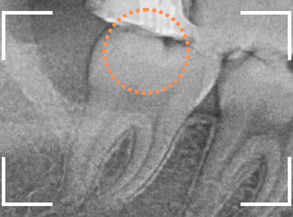 つめものの下の深い深い虫歯19-2